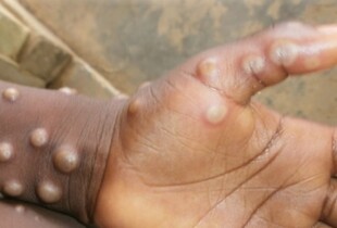 ВООЗ оголосила спалах вірусу mpox НС світового масштабу 