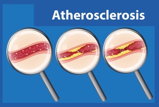 Атеросклероз брахіоцефальних, а саме сонних (каротидних) артерій