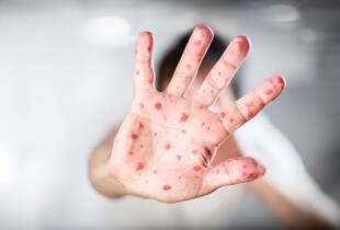 Спалах кору в США: вже понад 900 випадків з січня, вперше з 2003 року від хвороби померли діти