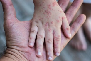 Що робити, якщо висипання у дитини не зникають: рекомендації дерматолога