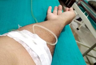 У США мешканець штату Аризона помер від чуми після контакту із мертвою твариною – ЗМІ