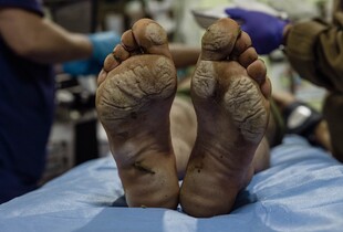 Медеваки в Покровськ не заїжджають: бойовий медик про евакуацію поранених з міста