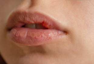 Сохнуть і лущаться губи на вулиці: в чому причина і як цього позбутися 