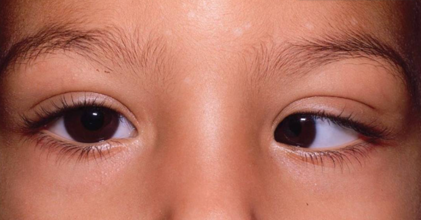 Косоокість у дітей: як розпізнати проблему і чому важливо лікувати її вчасно