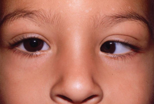Косоокість у дітей: як розпізнати проблему і чому важливо лікувати її вчасно