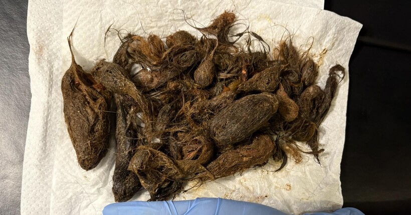 Синдром Рапунцель: на Волині зі шлунка семирічної дівчинки видалили майже кілограм волосся