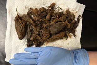 Синдром Рапунцель: на Волині зі шлунка семирічної дівчинки видалили майже кілограм волосся