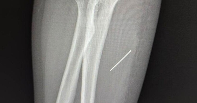 На Львівщині 13-річна дівчинка кілька днів жила з голкою в руці: подробиці інциденту 