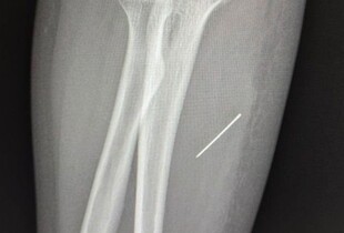 На Львівщині 13-річна дівчинка кілька днів жила з голкою в руці: подробиці інциденту 