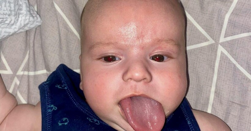 Язик у п'ять разів довший: українські медики прооперували малюка з рідкісним синдромом (фото)