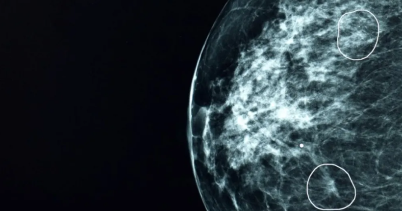 У Великій Британії штучний інтелект виявив 11 випадків раку, які пропустили лікарі