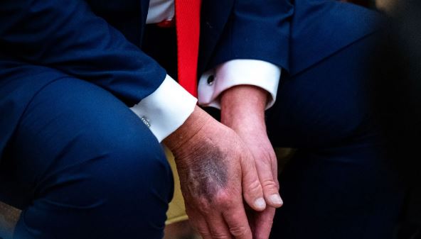 трамп рука синець